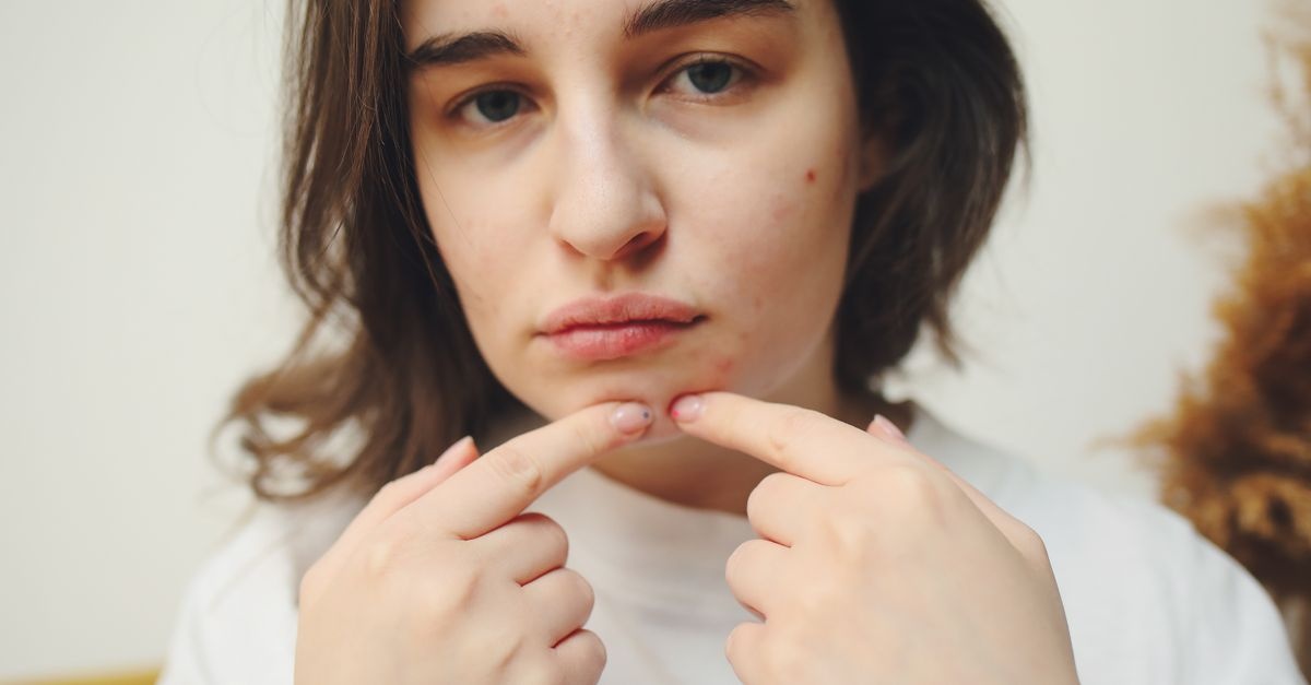 Ujarzmij trądzik hormonalny w dorosłym wieku — naturalnie, łagodnie, skutecznie