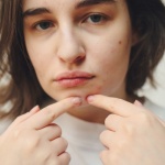 Ujarzmij trądzik hormonalny w dorosłym wieku — naturalnie, łagodnie, skutecznie